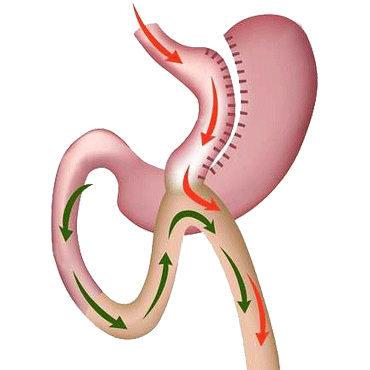 Bypass gastrique Tunisie