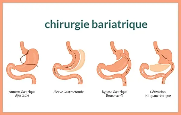 chirurgie bariatrique