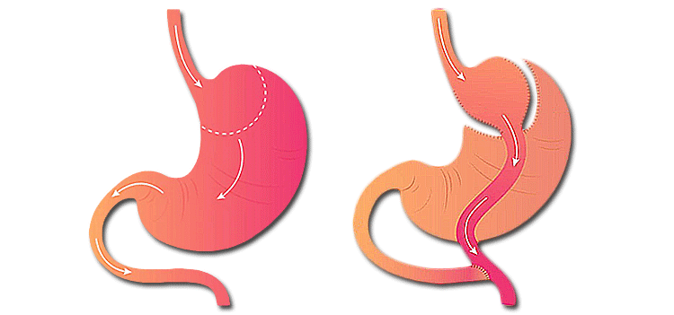 Ballon gastrique illustration